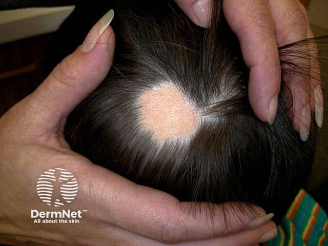 A hairless occipital patch in a child - the nevus sebaceous may become thicker and verrucous at puberty
