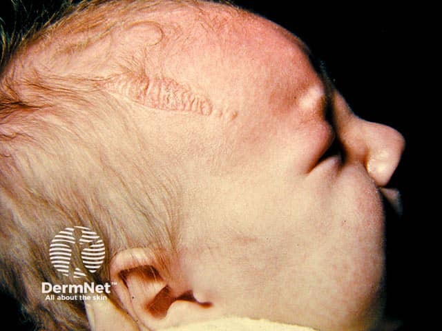 A linear naevus sebaceous on the forehead - the thickening is in part due to maternal hormonal effects, and it may flatten later in infancy