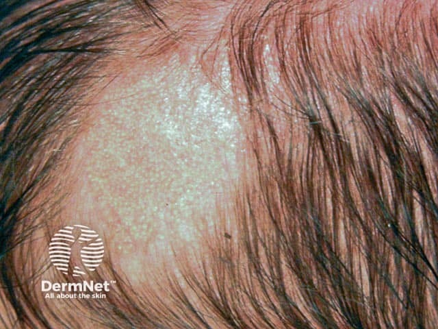 A typical area of alopecia in an infant due to a naevus sebaceous
