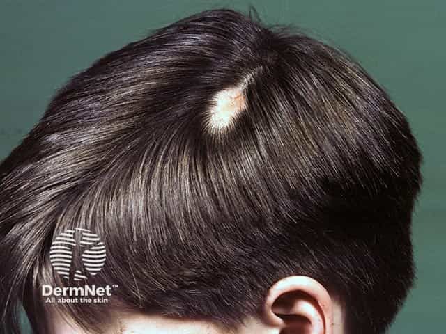 A patch of alopecia in a boy due to a naevus sebaceous
