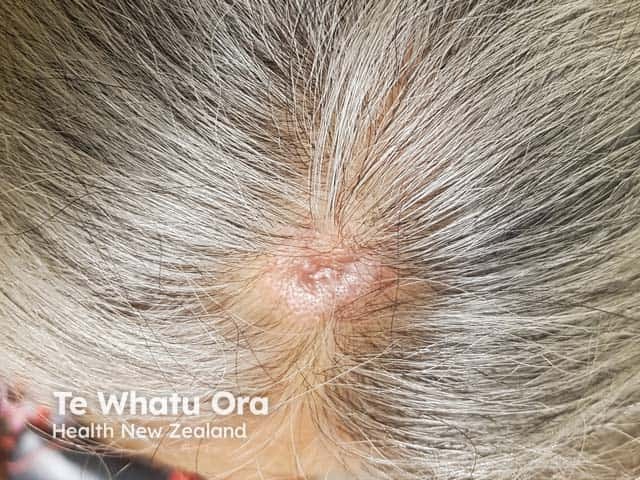 A naevus sebaceous on the scalp of a 59 year old Maori
