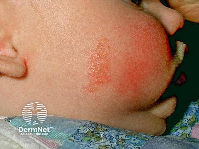 A naevus sebaceous on the right cheek in an infant  - the orange-yellow colour is characteristic
