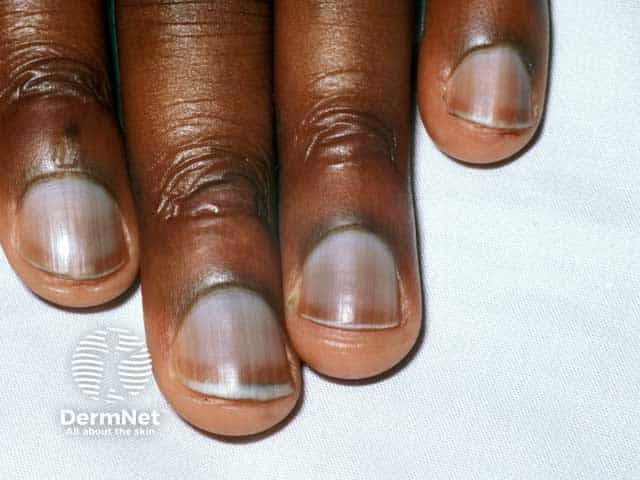 Blue nails due to HIV infection