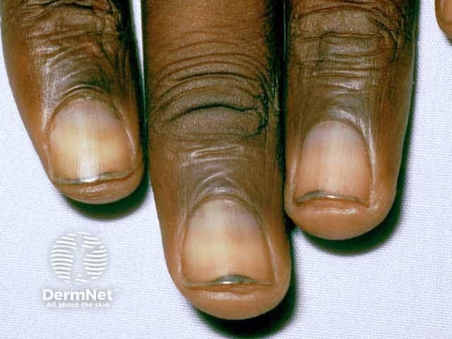 Blue nails in HIV infection