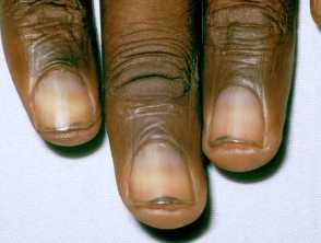 Blue nails in a child with HIV infection  Archives of Disease in Childhood