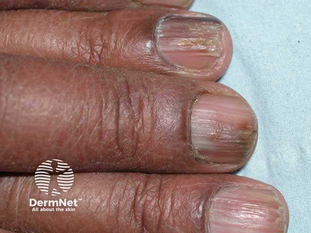 Ridging and roughness (onychorrhexis) of the finger nail plates due to nail unit lichen planus