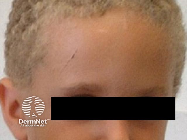 Woolly hair in Naxos syndrome