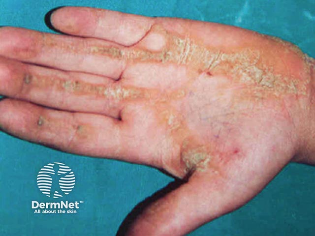Palmar keratoderma in Naxos syndrome