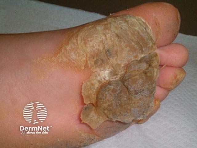 Plantar keratoderma in Naxos syndrome