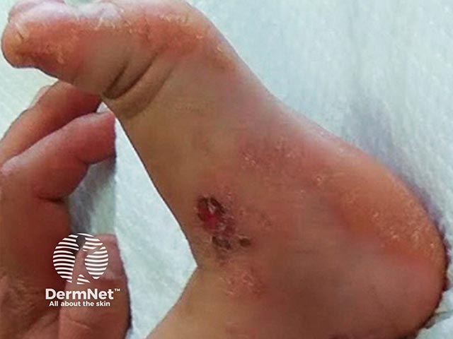 Plantar keratoderma in Naxos syndrome