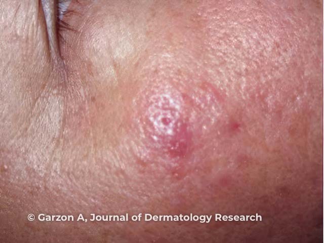 Red plaques on the cheek