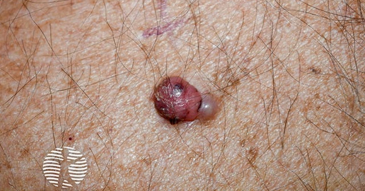 Nodular melanoma image