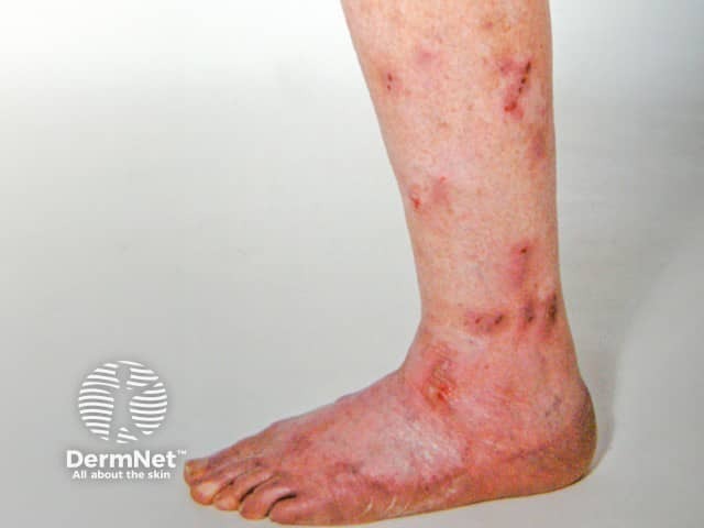Excoriated prurigo lesions on the legs