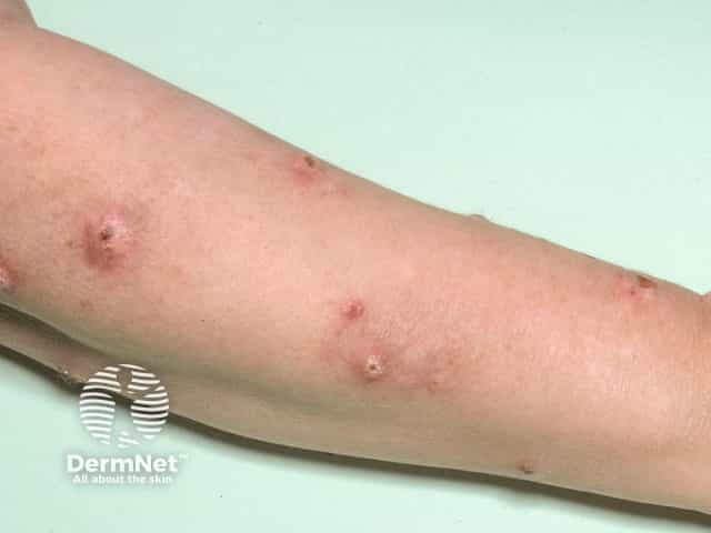Large lesions of nodular prurigo on the arm
