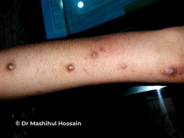 Nodular prurigo: in skin of colour