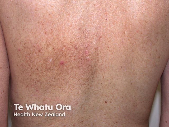 Scratching due to notalgia paraesthetica causing hyperpigmentation over the left scapula