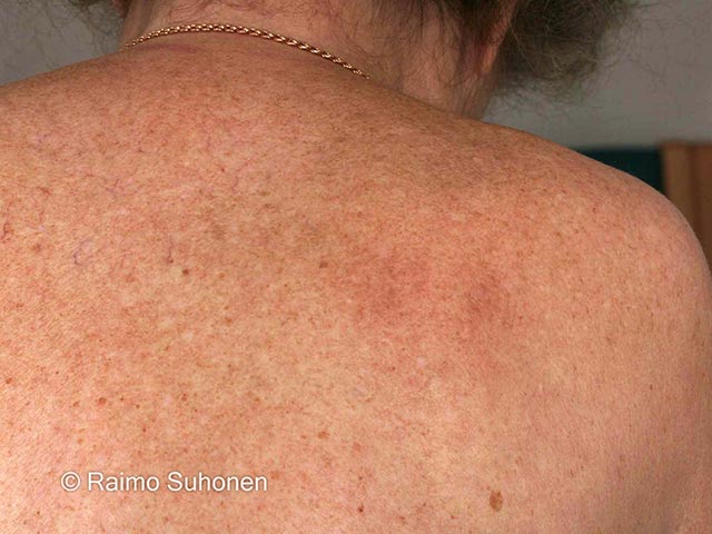 Notalgia over the mid scapula area