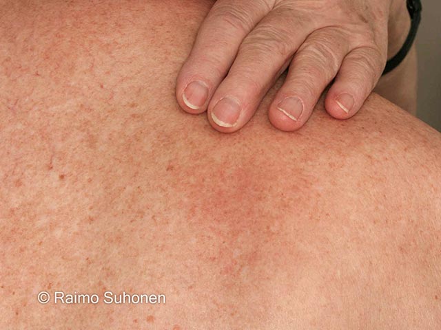 Close up of an area of notalgia paraesthetica