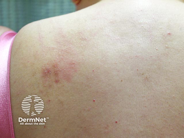 Redness and papules due to scratching an area of notalgia
