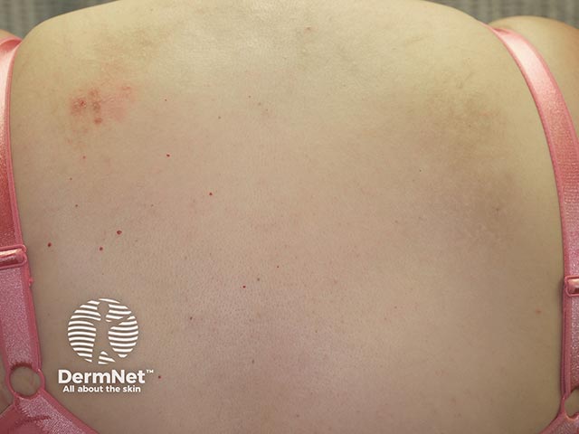 Excoriations due to notalgia on the upper back