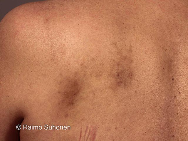 Pigmentation due to longstanding scratching of an area of notalgia
