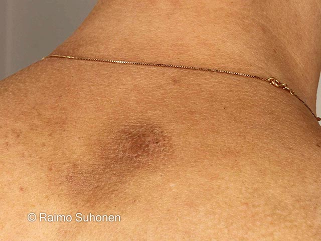 Rippled pigmentation and lichenification due to notalgia