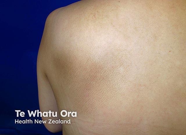 Rippled pigmentation over the scapula due to longstanding notalgia - biopsy often shows dermal depositis of amyloid