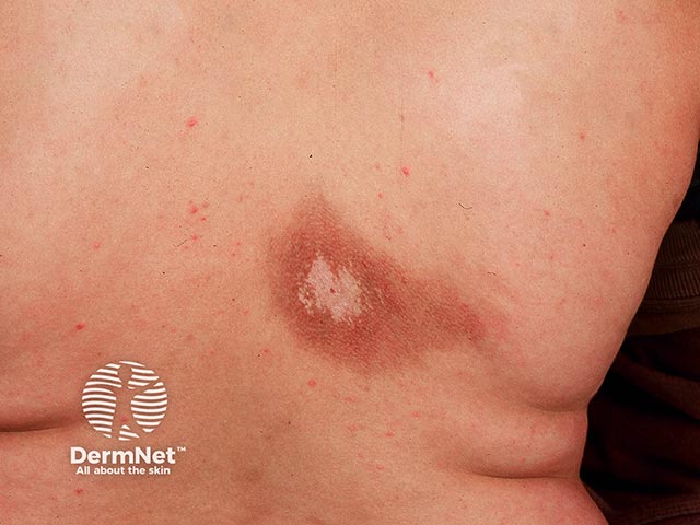 Unusually florid pigmentation and hypopigmentation in notalgia