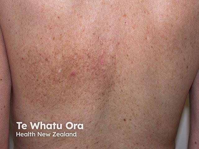 Scratching due to notalgia paraesthetica causing hyperpigmentation over the left scapula