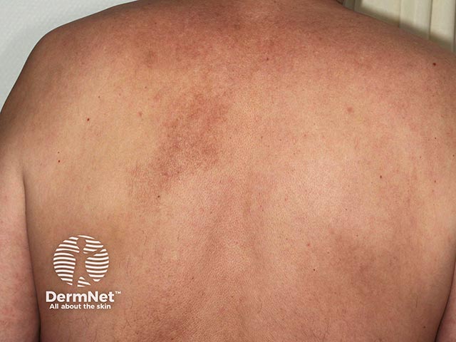 Pigmentation from repetitive scratching due to notalgia paraesthetica of the left upper back