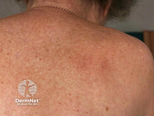 Notalgia over the mid scapula area