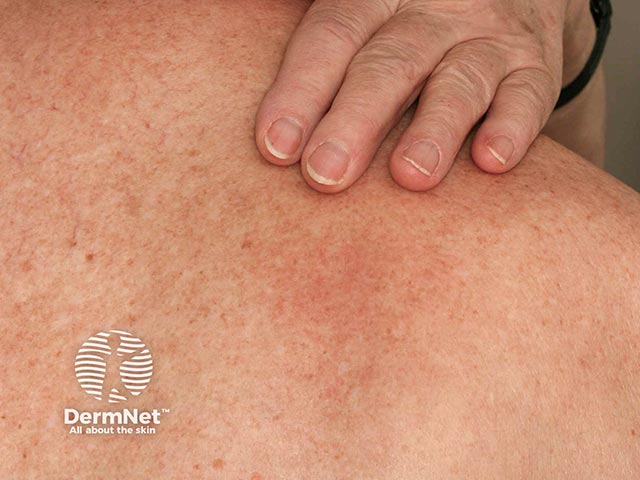 Close up of an area of notalgia paraesthetica