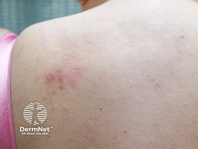 Redness and papules due to scratching an area of notalgia