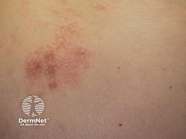 Close up of localised excoriations due to notalgia