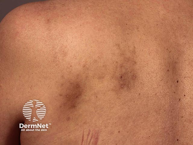 Pigmentation due to longstanding scratching of an area of notalgia