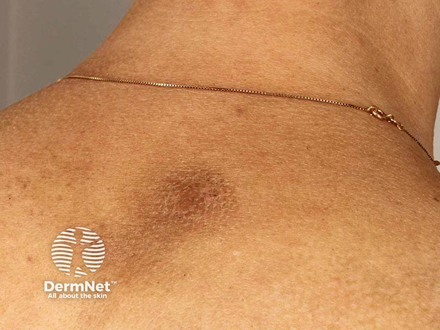 Rippled pigmentation and lichenification due to notalgia