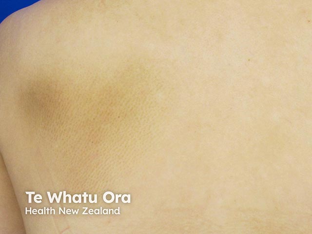 Rippled pigmentation over the scapula due to longstanding notalgia - biopsy often shows dermal depositis of amyloid