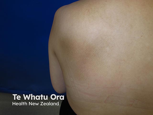 Rippled pigmentation over the scapula due to longstanding notalgia - biopsy often shows dermal depositis of amyloid