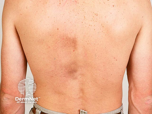 Notalgia in both the typical location and extending down to the lumbar back