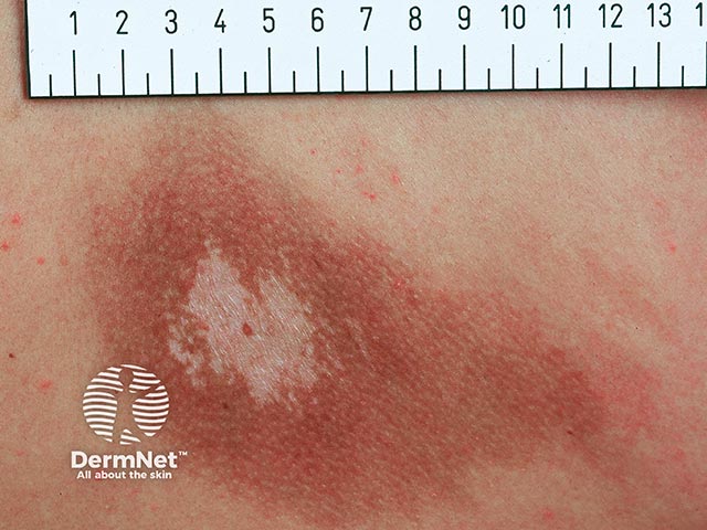 Unusually florid pigmentation and hypopigmentation in notalgia