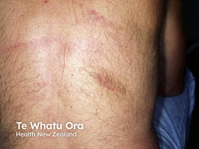 Notalgia paraesthetica producing pigmentation over the lower pole of the scapula