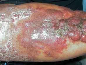 Obesity-associated lymphoedematous mucinosis