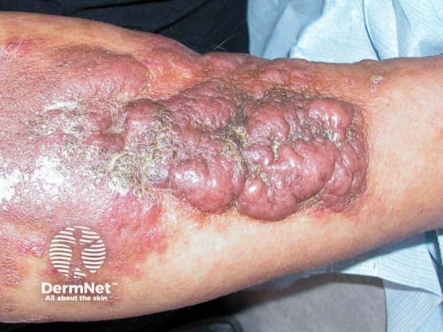 Florid plaques of obesity-associated lymphoedematous mucinosis on the shins