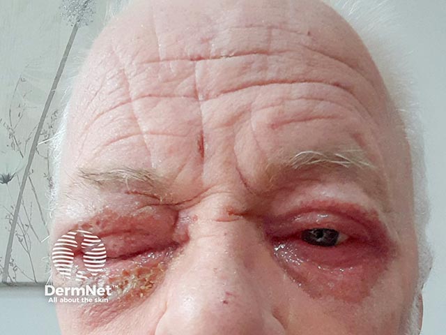 Severe blepharoconjunctivitis that arose within 8 weeks of dupilumab introduction