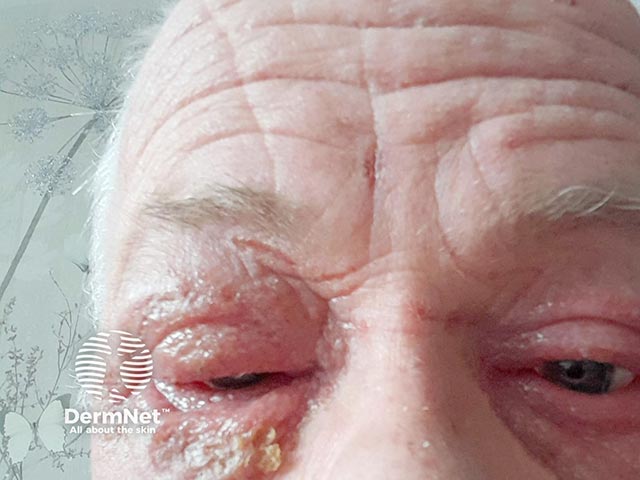 Severe blepharoconjunctivitis that arose within 8 weeks of dupilumab introduction