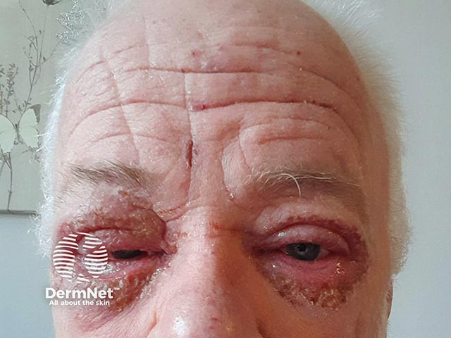 Severe blepharoconjunctivitis that arose within 8 weeks of dupilumab introduction