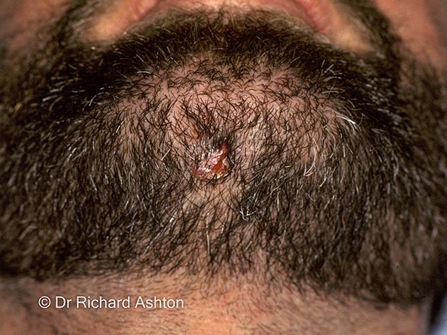 A dental sinus within the beard area