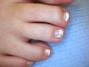Fungal Nail Infections — DermNet