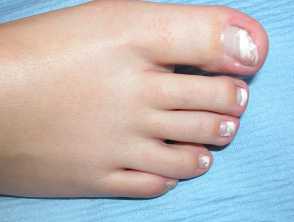 White nail - Leukonychia: An overview — DermNet
