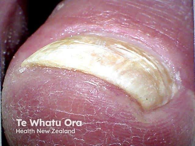 Superficial white onychomycosis - note the absence of thickening of the nail plate